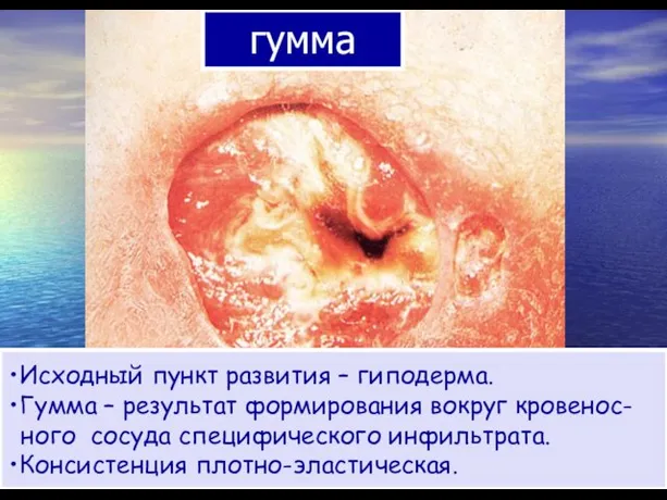 Исходный пункт развития – гиподерма. Гумма – результат формирования вокруг кровенос-