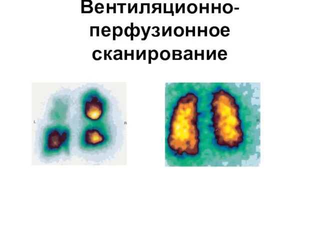 Вентиляционно-перфузионное сканирование