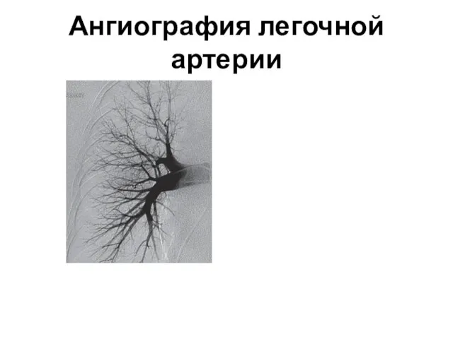 Ангиография легочной артерии