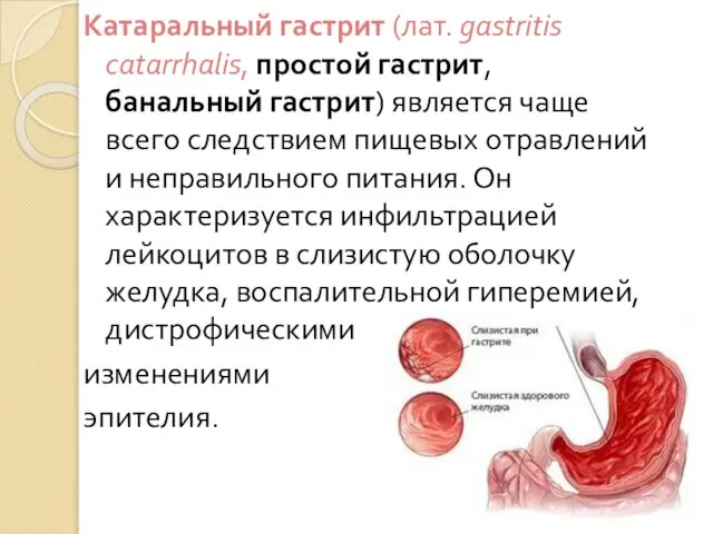 Катаральный гастрит (лат. gastritis catarrhalis, простой гастрит, банальный гастрит) является чаще