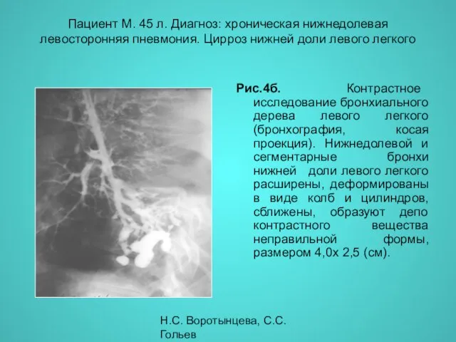 Н.С. Воротынцева, С.С. Гольев Рентгенопульмонология Пациент М. 45 л. Диагноз: хроническая