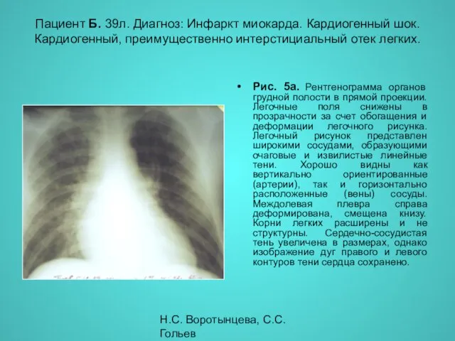 Н.С. Воротынцева, С.С. Гольев Рентгенопульмонология Пациент Б. 39л. Диагноз: Инфаркт миокарда.