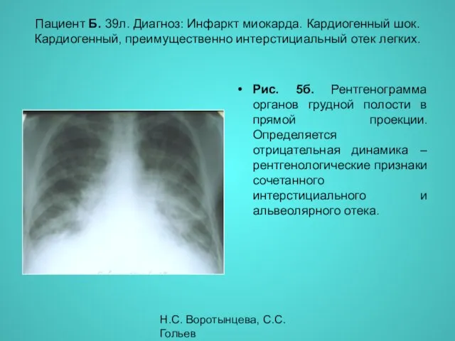 Н.С. Воротынцева, С.С. Гольев Рентгенопульмонология Пациент Б. 39л. Диагноз: Инфаркт миокарда.