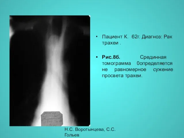 Н.С. Воротынцева, С.С. Гольев Рентгенопульмонология Пациент К. 62г. Диагноз: Рак трахеи