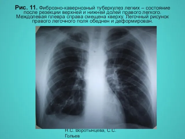 Н.С. Воротынцева, С.С. Гольев Рентгенопульмонология Рис. 11. Фиброзно-кавернозный туберкулез легких –