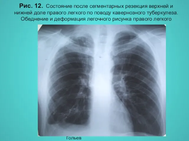 Н.С. Воротынцева, С.С. Гольев Рентгенопульмонология Рис. 12. Состояние после сегментарных резекция