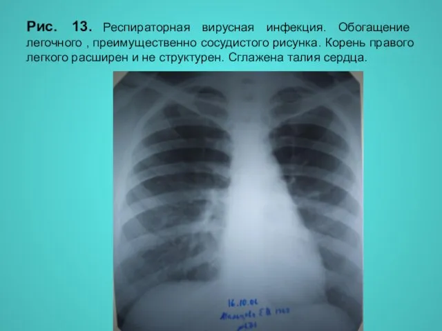 Н.С. Воротынцева, С.С. Гольев Рентгенопульмонология Рис. 13. Респираторная вирусная инфекция. Обогащение