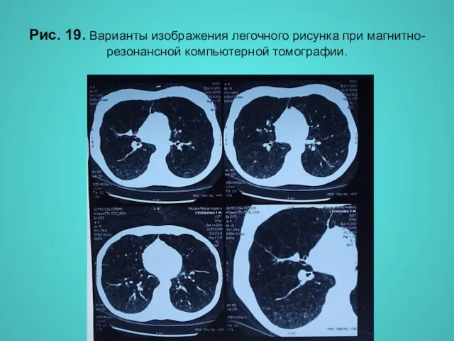 Н.С. Воротынцева, С.С. Гольев Рентгенопульмонология Рис. 19. Варианты изображения легочного рисунка при магнитно-резонансной компьютерной томографии.