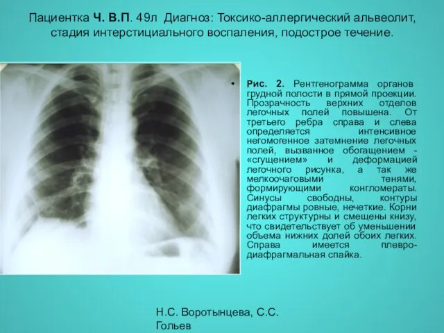 Н.С. Воротынцева, С.С. Гольев Рентгенопульмонология Пациентка Ч. В.П. 49л Диагноз: Токсико-аллергический