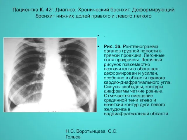 Н.С. Воротынцева, С.С. Гольев Рентгенопульмонология Пациентка К. 42г. Диагноз: Хронический бронхит.