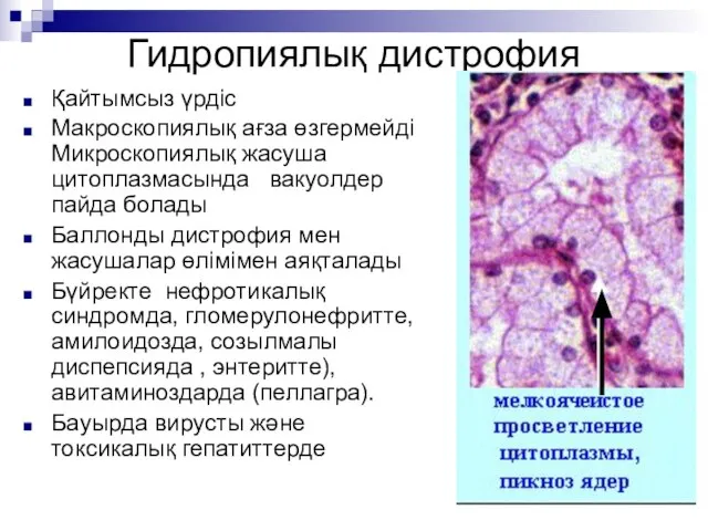 Гидропиялық дистрофия Қайтымсыз үрдіс Макроскопиялық ағза өзгермейді Микроскопиялық жасуша цитоплазмасында вакуолдер