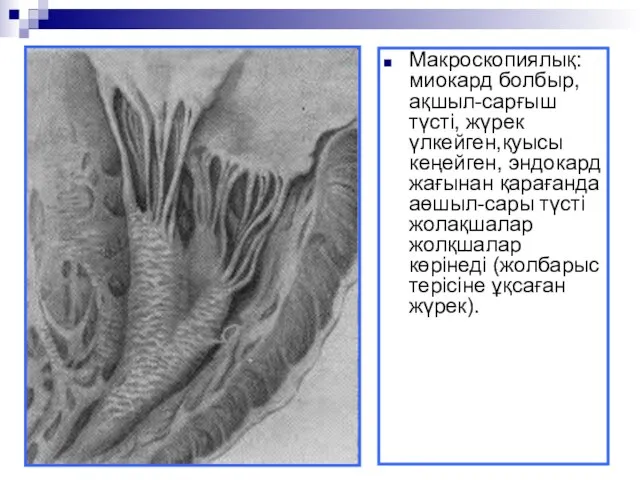 Макроскопиялық: миокард болбыр, ақшыл-сарғыш түсті, жүрек үлкейген,қуысы кеңейген, эндокард жағынан қарағанда