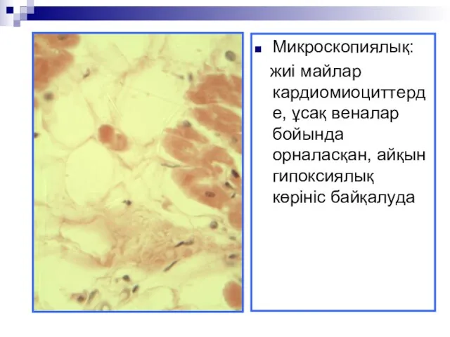 Микроскопиялық: жиі майлар кардиомиоциттерде, ұсақ веналар бойында орналасқан, айқын гипоксиялық көрініс байқалуда