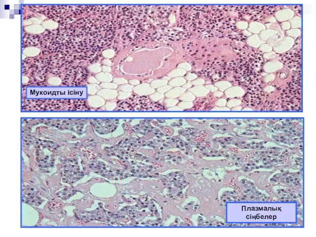 Плазмалық сіңбелер Мукоидты ісіну