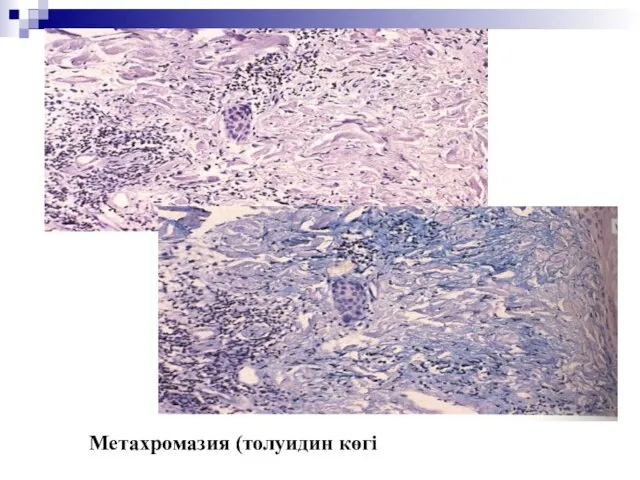 Метахромазия (толуидин көгі