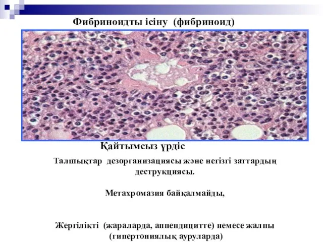 Фибриноидты ісіну (фибриноид) Қайтымсыз үрдіс Талшықтар дезорганизациясы және негізгі заттардың деструкциясы.