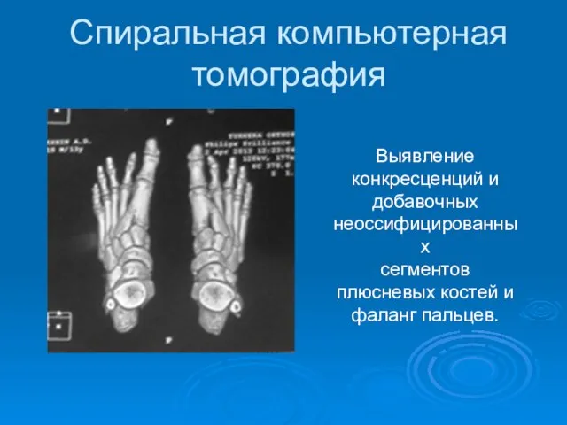 Спиральная компьютерная томография Выявление конкресценций и добавочных неоссифицированных сегментов плюсневых костей и фаланг пальцев.