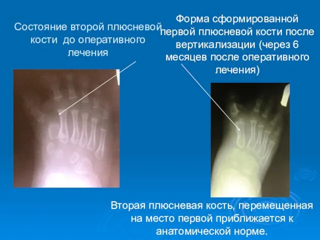 Форма сформированной первой плюсневой кости после вертикализации (через 6 месяцев после