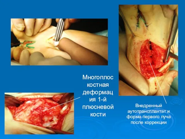 Многоплоскостная деформация 1-й плюсневой кости Внедренный аутотрансплантат и форма первого луча после коррекции