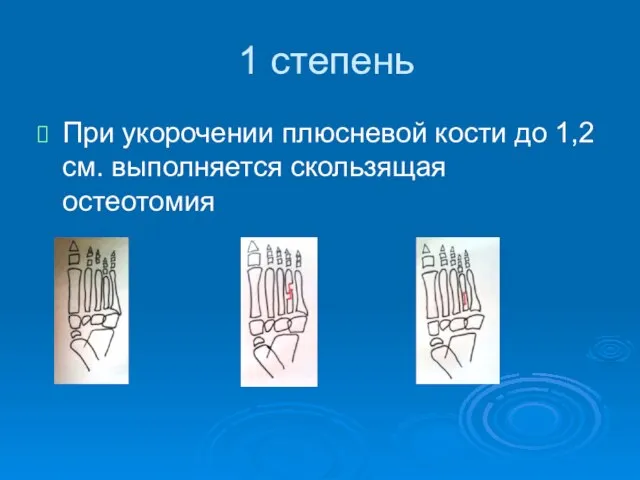 1 степень При укорочении плюсневой кости до 1,2 см. выполняется скользящая остеотомия