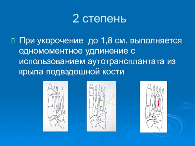 2 степень При укорочение до 1,8 см. выполняется одномоментное удлинение с