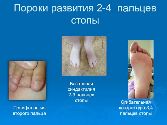 Пороки развития 2-4 пальцев стопы Полифалангия второго пальца Сгибательная контрактура 3,4