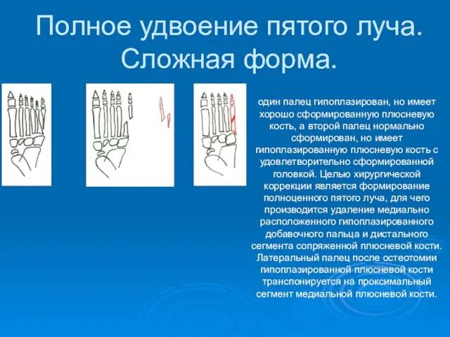 Полное удвоение пятого луча. Сложная форма. один палец гипоплазирован, но имеет