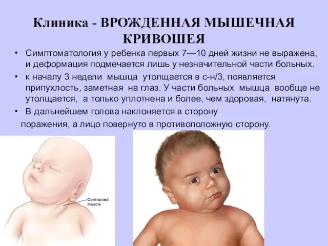 Клиника - ВРОЖДЕННАЯ МЫШЕЧНАЯ КРИВОШЕЯ Симптоматология у ребенка первых 7—10 дней