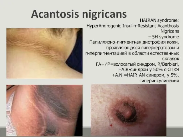 Acantosis nigricans HAIRAN syndrome: HyperAndrogenic Insulin-Resistant Acanthosis Nigricans – 5H syndrome