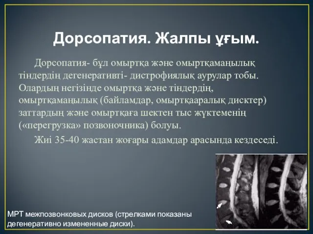 Дорсопатия. Жалпы ұғым. Дорсопатия- бұл омыртқа және омыртқамаңылық тіндердің дегенеративті- дистрофиялық