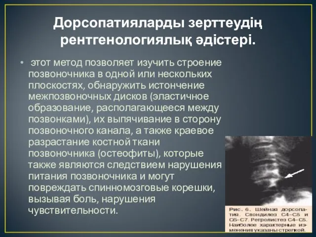 Дорсопатияларды зерттеудің рентгенологиялық әдістері. этот метод позволяет изучить строение позвоночника в