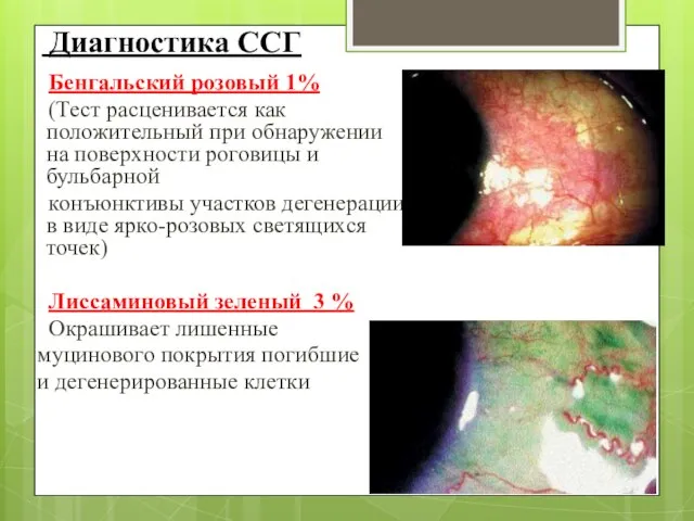 Диагностика ССГ Бенгальский розовый 1% (Тест расценивается как положительный при обнаружении