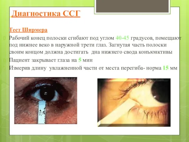 Диагностика ССГ Тест Ширмера Рабочий конец полоски сгибают под углом 40-45