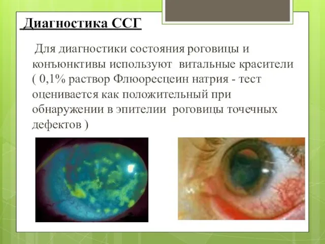 Диагностика ССГ Для диагностики состояния роговицы и конъюнктивы используют витальные красители