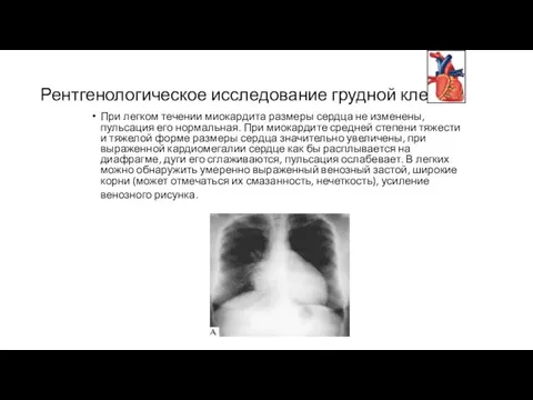 Рентгенологическое исследование грудной клетки. При легком течении миокардита размеры сердца не