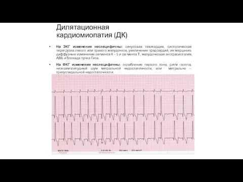 На ЭКГ изменения неспецифичны: синусовая тахикардия, систолическая перегрузка левого или правого