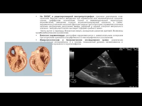 На ЭХОКГ и радионуклеидной вентрикулографии: признаки увеличения всех полостей, больше левого