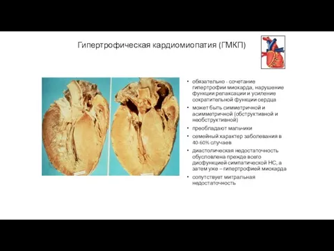 Гипертрофическая кардиомиопатия (ГМКП) обязательно - сочетание гипертрофии миокарда, нарушение функции релаксации
