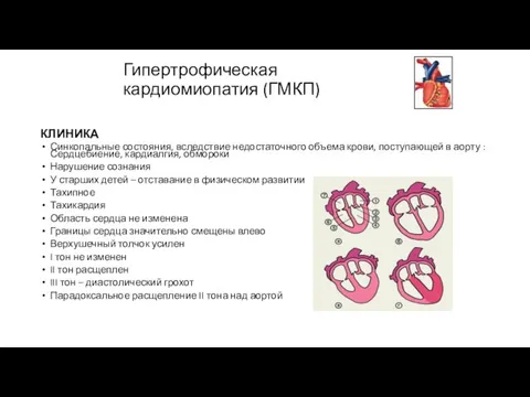 Гипертрофическая кардиомиопатия (ГМКП) КЛИНИКА Синкопальные состояния, вследствие недостаточного объема крови, поступающей