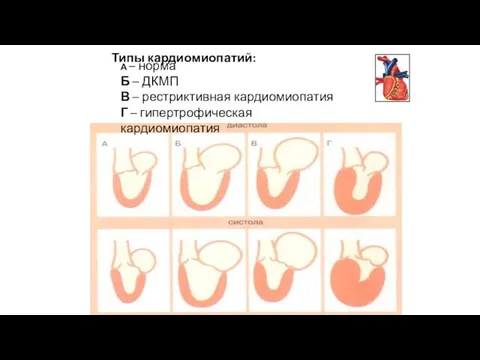 Типы кардиомиопатий: А – норма Б – ДКМП В – рестриктивная кардиомиопатия Г – гипертрофическая кардиомиопатия