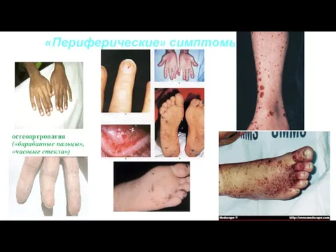 «Периферические» симптомы: остеоартропатия («барабанные пальцы», «часовые стекла»)