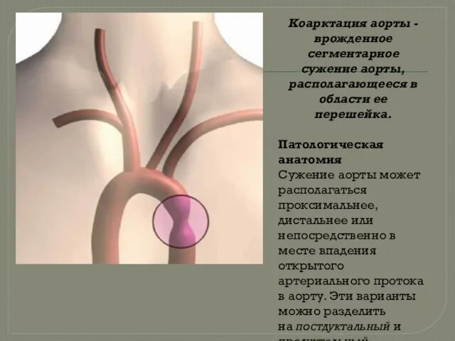 Коарктация аорты - врожденное сегментарное сужение аорты, располагающееся в области ее