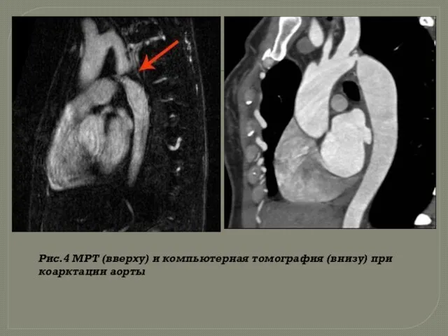 Рис.4 МРТ (вверху) и компьютерная томография (внизу) при коарктации аорты