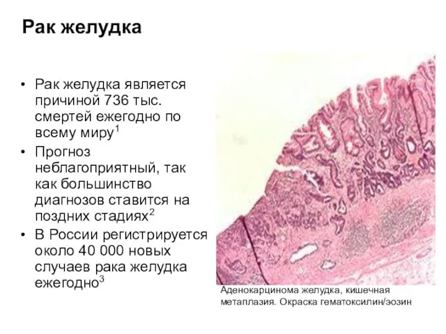 Рак желудка Рак желудка является причиной 736 тыс. смертей ежегодно по