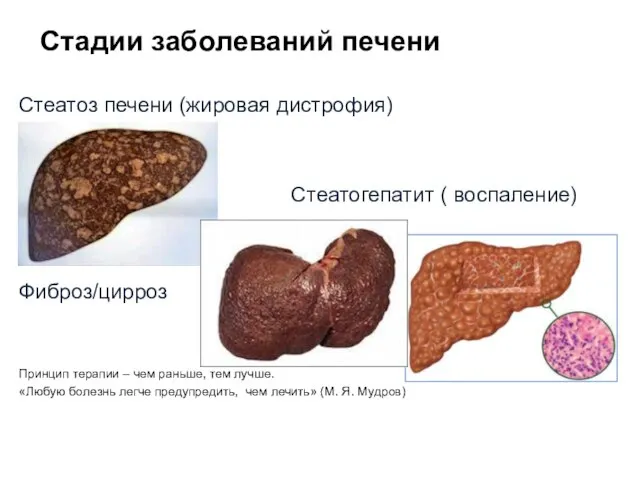 Стадии заболеваний печени Стеатоз печени (жировая дистрофия) Стеатогепатит ( воспаление) Фиброз/цирроз