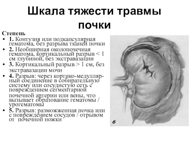 Шкала тяжести травмы почки Степень 1. Контузия или подкапсулярная гематома, без