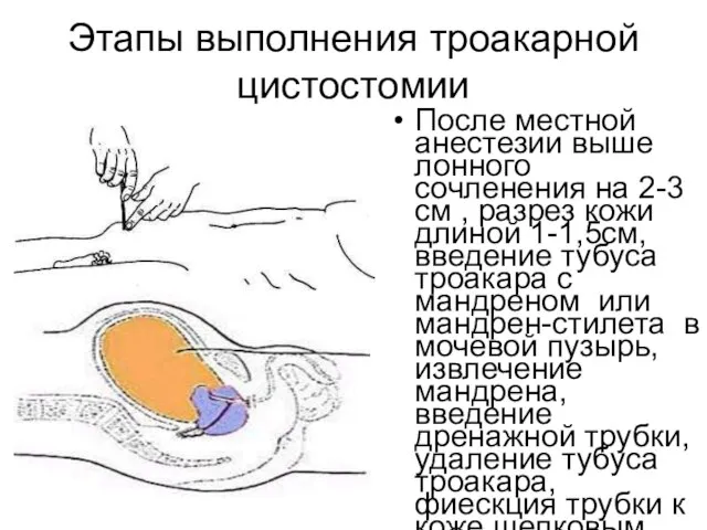 Этапы выполнения троакарной цистостомии После местной анестезии выше лонного сочленения на