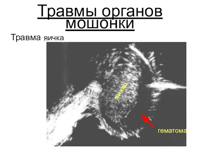 Травмы органов мошонки Травма яичка яичко гематома