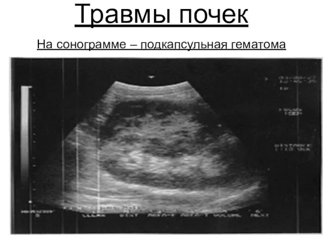 Травмы почек На сонограмме – подкапсульная гематома