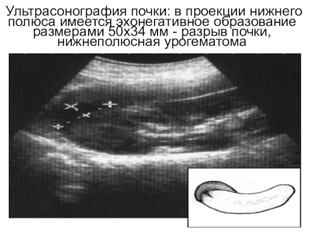 Ультрасонография почки: в проекции нижнего полюса имеется эхонегативное образование размерами 50х34